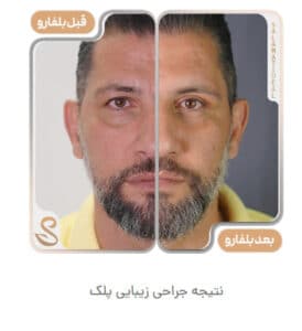 نمونه کار جراحی پلک کلینیک سلامت ایده آل در مشهد