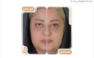 نمونه کار جراحی پلک کلینیک سلامت ایده آل در مشهد