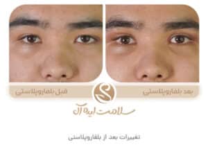 نمونه کار جراحی پلک کلینیک سلامت ایده آل در مشهد