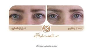 نمونه کار جراحی پلک کلینیک سلامت ایده آل در مشهد