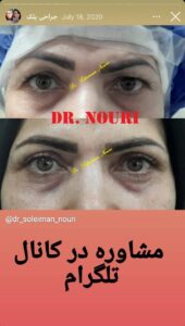 نمونه کار جراحی پلک دکتر سلیمان نوری ( کلینیک مانا ) در مشهد