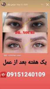 نمونه کار جراحی پلک دکتر سلیمان نوری ( کلینیک مانا ) در مشهد