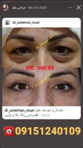نمونه کار جراحی پلک دکتر سلیمان نوری ( کلینیک مانا ) در مشهد