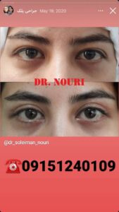 نمونه کار جراحی پلک دکتر سلیمان نوری ( کلینیک مانا ) در مشهد