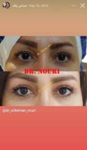 نمونه کار جراحی پلک دکتر سلیمان نوری ( کلینیک مانا ) در مشهد
