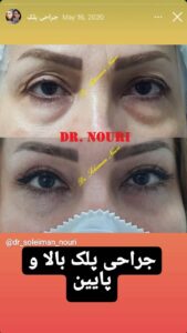 نمونه کار جراحی پلک دکتر سلیمان نوری ( کلینیک مانا ) در مشهد