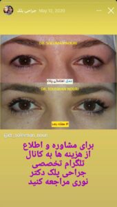 نمونه کار جراحی پلک دکتر سلیمان نوری ( کلینیک مانا ) در مشهد