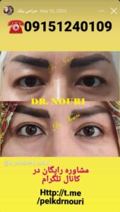 نمونه کار جراحی پلک دکتر سلیمان نوری ( کلینیک مانا ) در مشهد