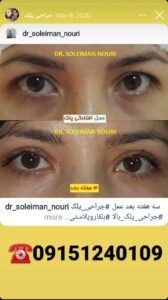 نمونه کار جراحی پلک دکتر سلیمان نوری ( کلینیک مانا ) در مشهد