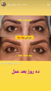نمونه کار جراحی پلک دکتر سلیمان نوری ( کلینیک مانا ) در مشهد