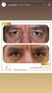 نمونه کار جراحی پلک دکتر نرگس رزم آرا در مشهد