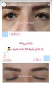 نمونه کار جراحی پلک دکتر نرگس رزم آرا در مشهد