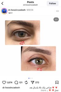 نمونه کار جراحی پلک دکتر ابوالفضل حسین زاده در مشهد