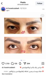 نمونه کار جراحی پلک دکتر ابوالفضل حسین زاده در مشهد