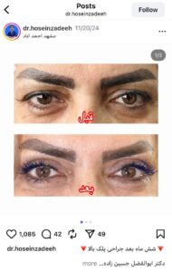 نمونه کار جراحی پلک دکتر ابوالفضل حسین زاده در مشهد