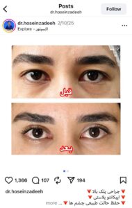 نمونه کار جراحی پلک دکتر ابوالفضل حسین زاده در مشهد