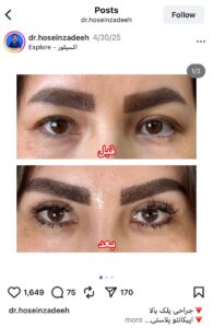 نمونه کار جراحی پلک دکتر ابوالفضل حسین زاده در مشهد