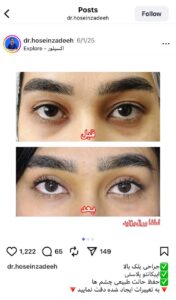 نمونه کار جراحی پلک دکتر ابوالفضل حسین زاده در مشهد