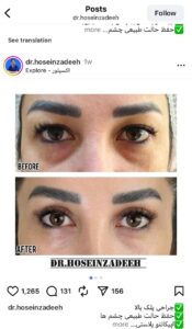 نمونه کار جراحی پلک دکتر ابوالفضل حسین زاده در مشهد