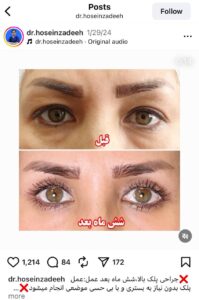 نمونه کار جراحی پلک دکتر ابوالفضل حسین زاده در مشهد