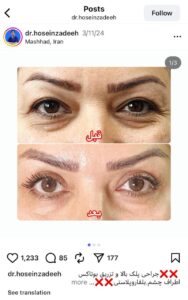 نمونه کار جراحی پلک دکتر ابوالفضل حسین زاده در مشهد