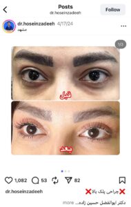 نمونه کار جراحی پلک دکتر ابوالفضل حسین زاده در مشهد