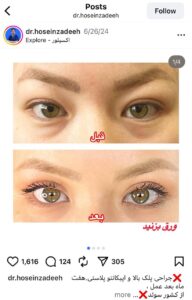 نمونه کار جراحی پلک دکتر ابوالفضل حسین زاده در مشهد