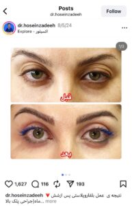 نمونه کار جراحی پلک دکتر ابوالفضل حسین زاده در مشهد