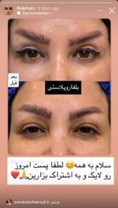نمونه کار جراحی پلک دکتر پدرام مجاور در مشهد