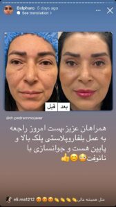 نمونه کار جراحی پلک دکتر پدرام مجاور در مشهد