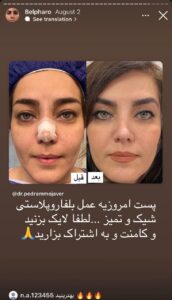 نمونه کار جراحی پلک دکتر پدرام مجاور در مشهد
