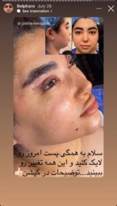 نمونه کار جراحی پلک دکتر پدرام مجاور در مشهد