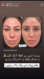 نمونه کار جراحی پلک دکتر پدرام مجاور در مشهد