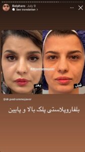 نمونه کار جراحی پلک دکتر پدرام مجاور در مشهد