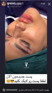 نمونه کار جراحی پلک دکتر پدرام مجاور در مشهد