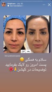 نمونه کار جراحی پلک دکتر پدرام مجاور در مشهد