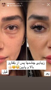 نمونه کار جراحی پلک دکتر پدرام مجاور در مشهد