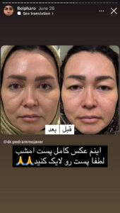 نمونه کار جراحی پلک دکتر پدرام مجاور در مشهد
