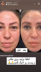 نمونه کار جراحی پلک دکتر پدرام مجاور در مشهد