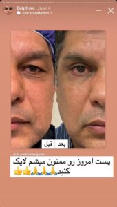 نمونه کار جراحی پلک دکتر پدرام مجاور در مشهد