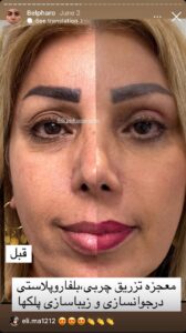 نمونه کار جراحی پلک دکتر پدرام مجاور در مشهد
