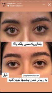 نمونه کار جراحی پلک دکتر پدرام مجاور در مشهد