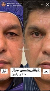 نمونه کار جراحی پلک دکتر پدرام مجاور در مشهد