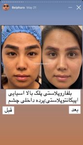 نمونه کار جراحی پلک دکتر پدرام مجاور در مشهد