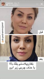 نمونه کار جراحی پلک دکتر پدرام مجاور در مشهد