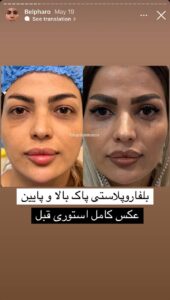 نمونه کار جراحی پلک دکتر پدرام مجاور در مشهد