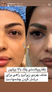نمونه کار جراحی پلک دکتر پدرام مجاور در مشهد