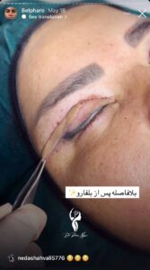 نمونه کار جراحی پلک دکتر پدرام مجاور در مشهد