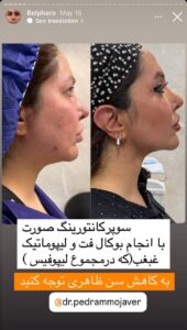 نمونه کار جراحی پلک دکتر پدرام مجاور در مشهد