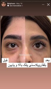 نمونه کار جراحی پلک دکتر پدرام مجاور در مشهد